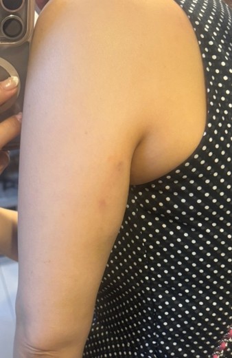 after photo: 脂肪溶解注射(肩)