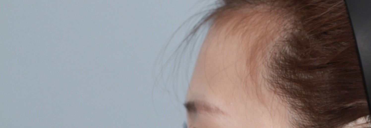 before photo: 이마필러, 관자놀이필러