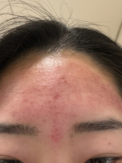 after photo: ダーマペン