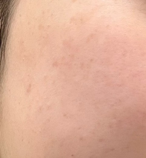 after photo: IPL(光/フォト治療)