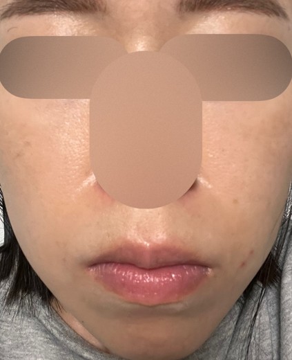 after photo: 脱毛(顔)