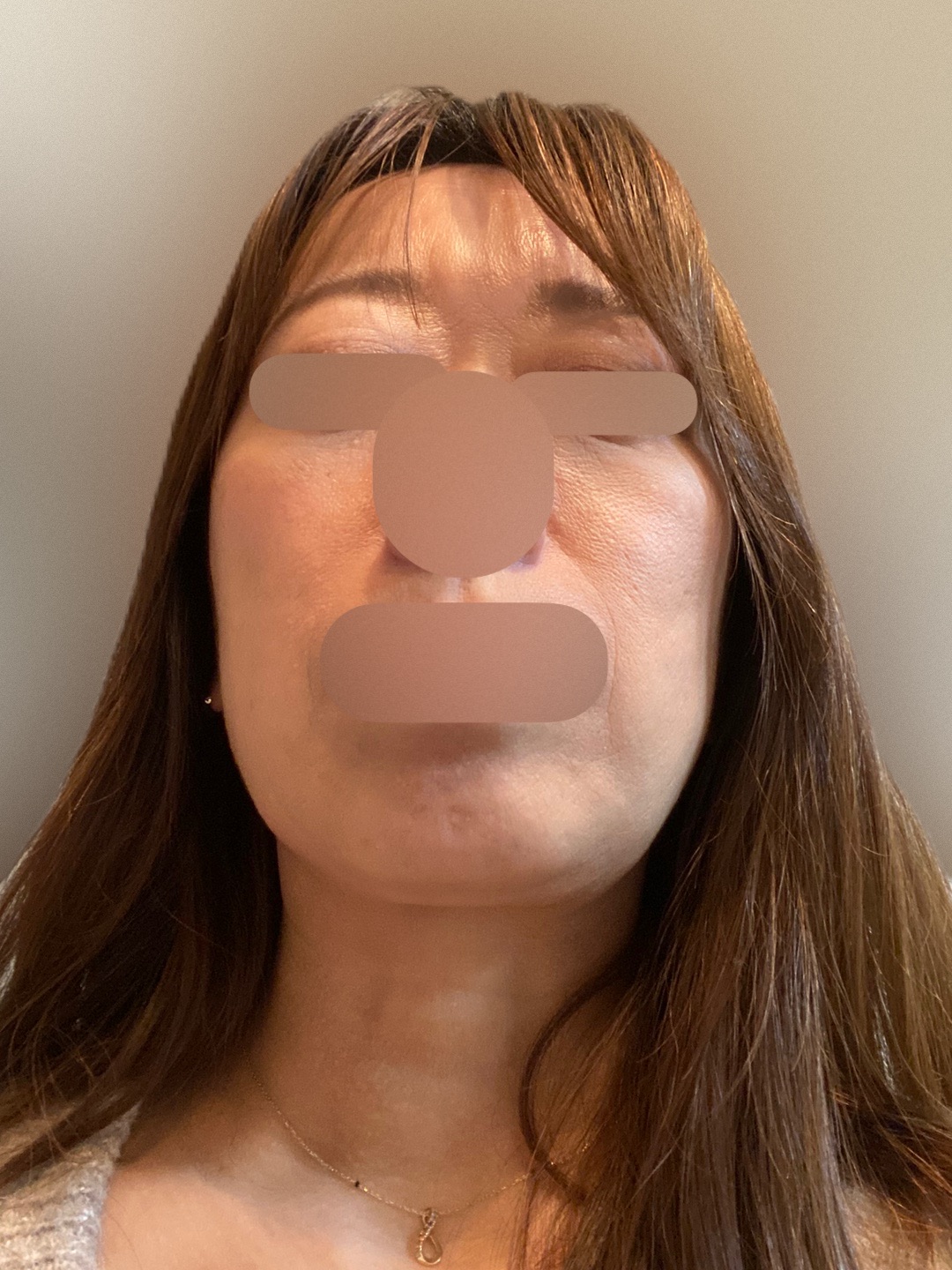 HIFU全顔650shot ウルトラフォーマーMPT【2月28日迄にご予約頂いた方