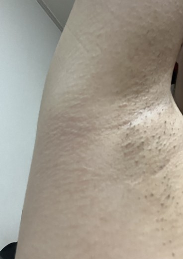 after photo: 겨드랑이제모