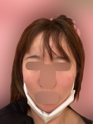 after photo: ハイドラフェイシャル
