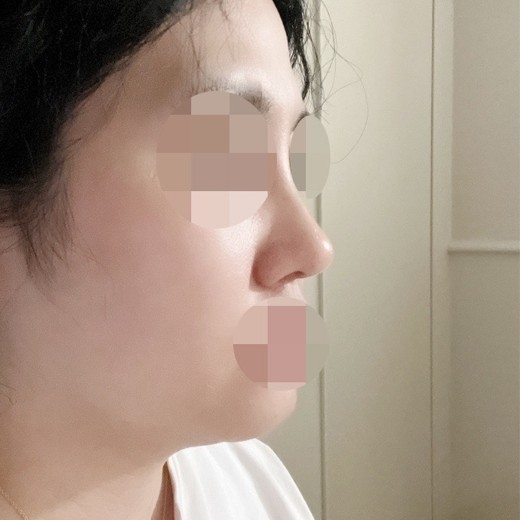 after photo: 콧볼축소