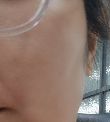 after photo: 피코토닝, 제네시스