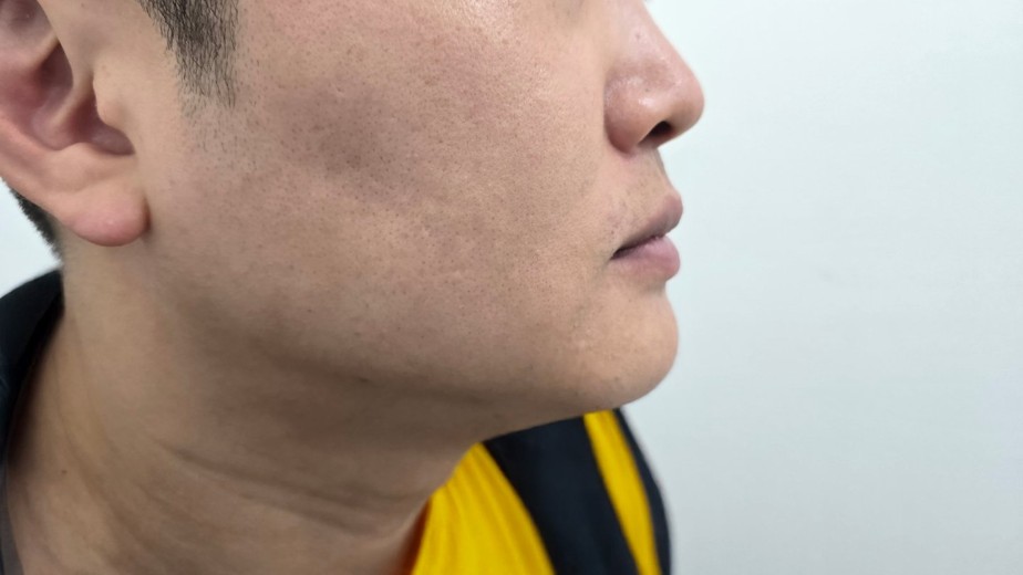 after photo: 울쎄라리프팅