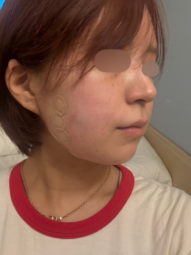 after photo: 脂肪溶解注射(顔)