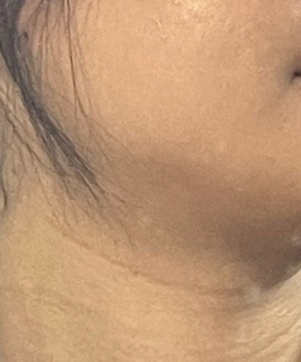 before photo: 인모드리프팅