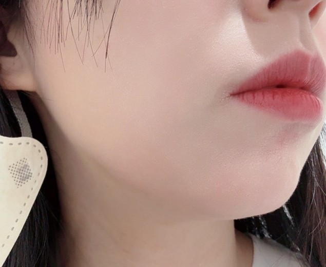 before photo: 脂肪溶解注射(顔)