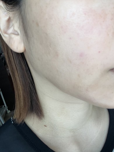 after photo: ダーマペン