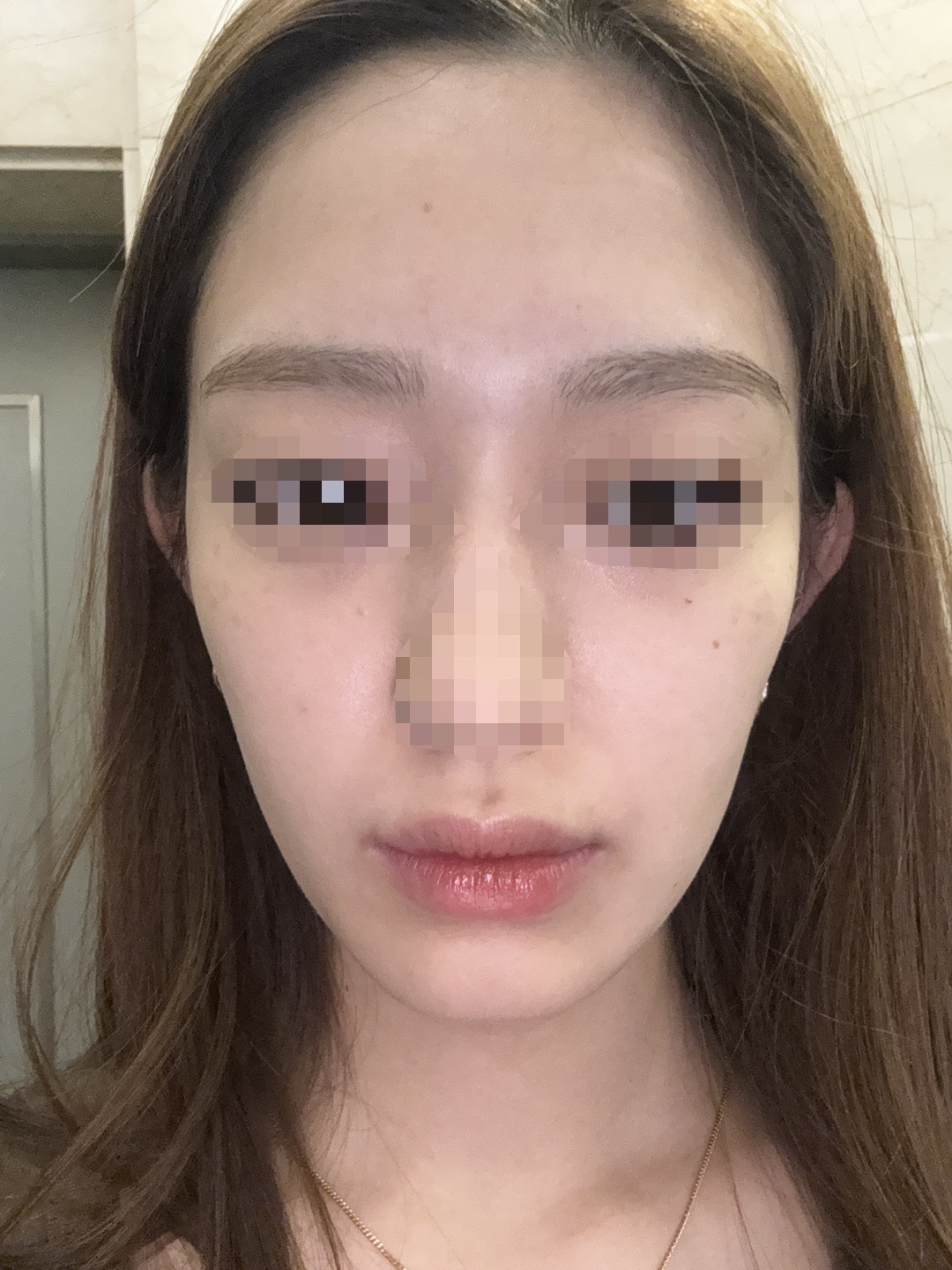 女性限定】顔脱毛｜ジェントルマックスプロ／ジェントルマックスプロ