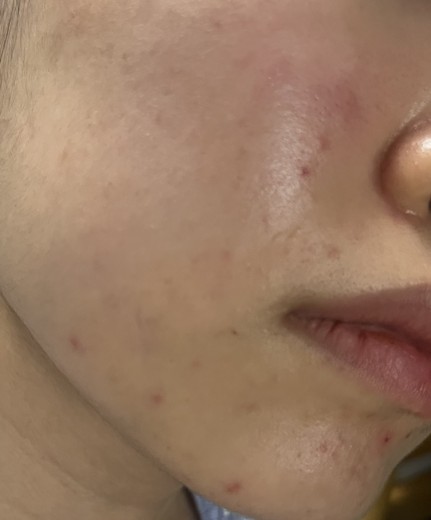 after photo: 여드름압출