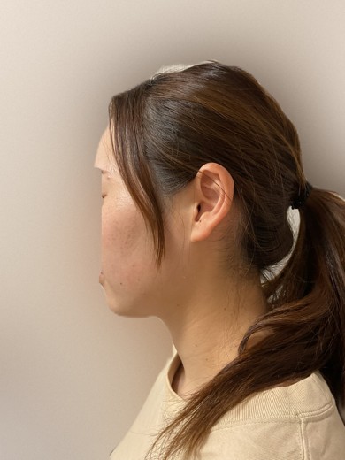 before photo: ハイフ(HIFU)