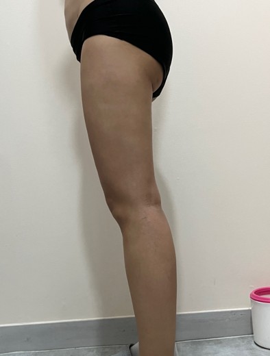 after photo: 복부지방흡입, 아르기닌수액