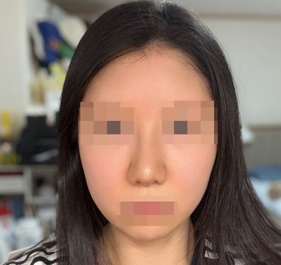 after photo: 코재수술, 콧대(보형물), 복코교정(수술)