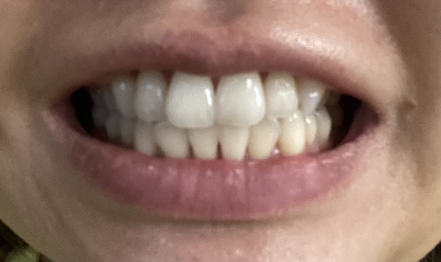 after photo: ホワイトニング