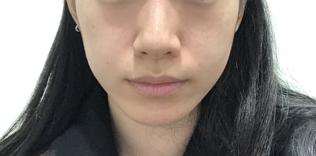 before photo: 입꼬리필러, 입술필러