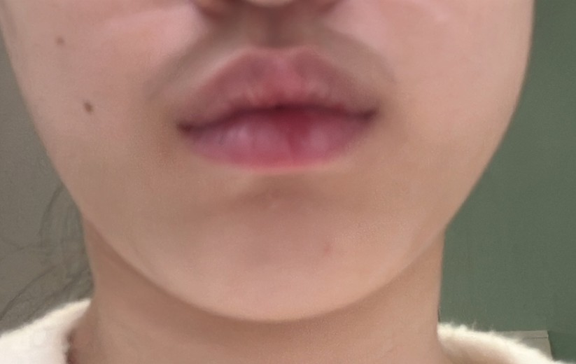 after photo: 사각턱보톡스, 슈링크유니버스