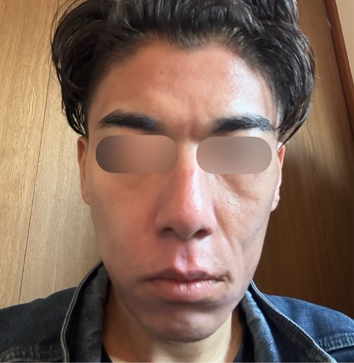 after photo: ダーマペン, エクソソーム