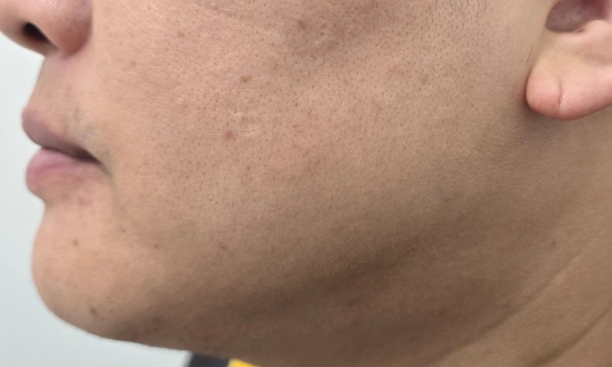 after photo: 울쎄라리프팅