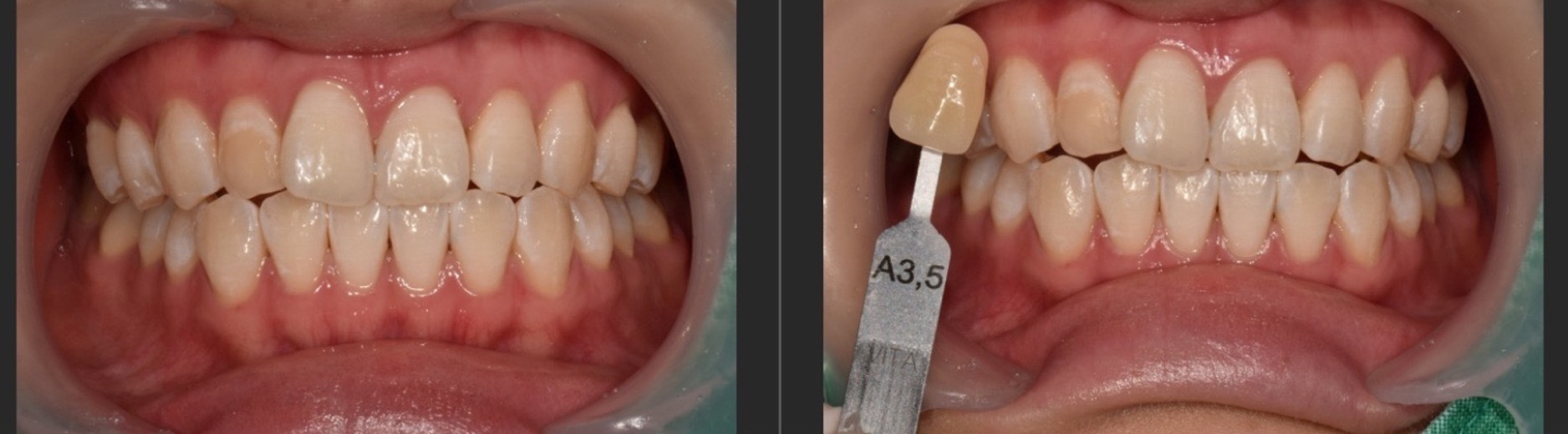 after photo: 치아미백