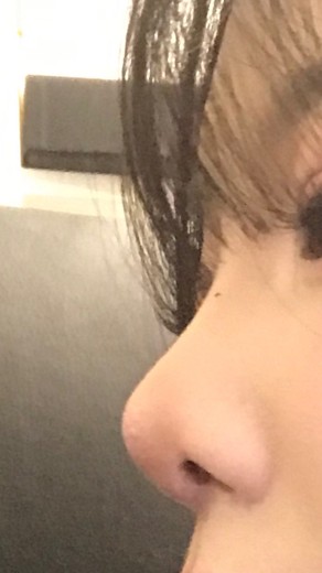 after photo: 콧대(보형물), 코끝(자가연골)