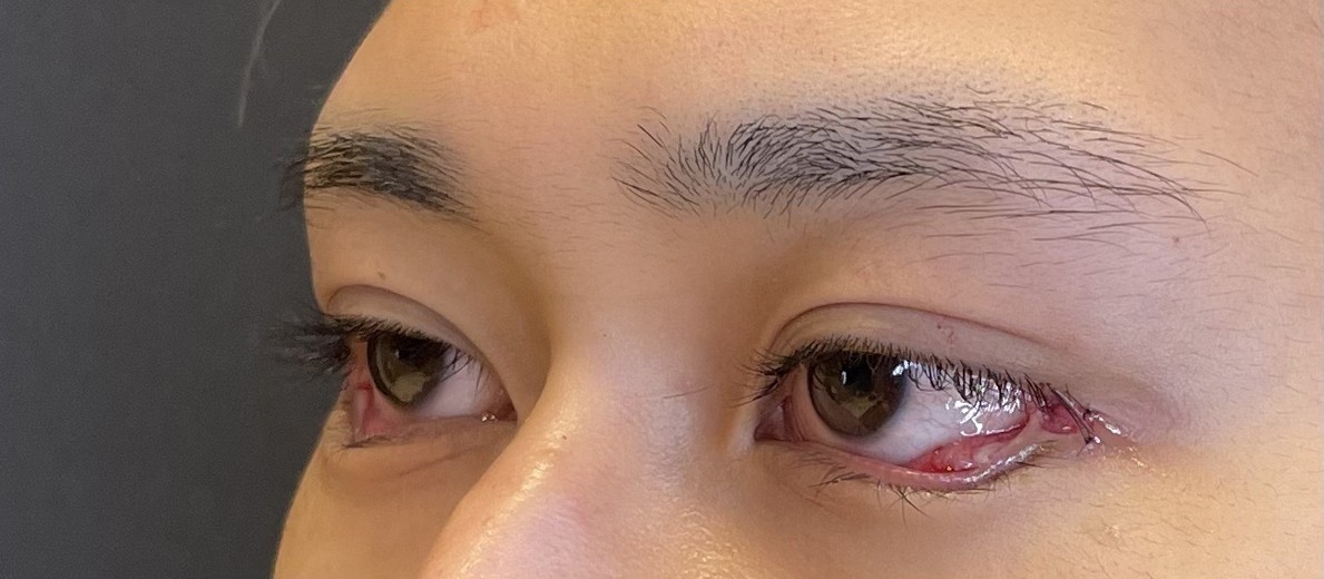 after photo: タレ目形成, 目尻切開