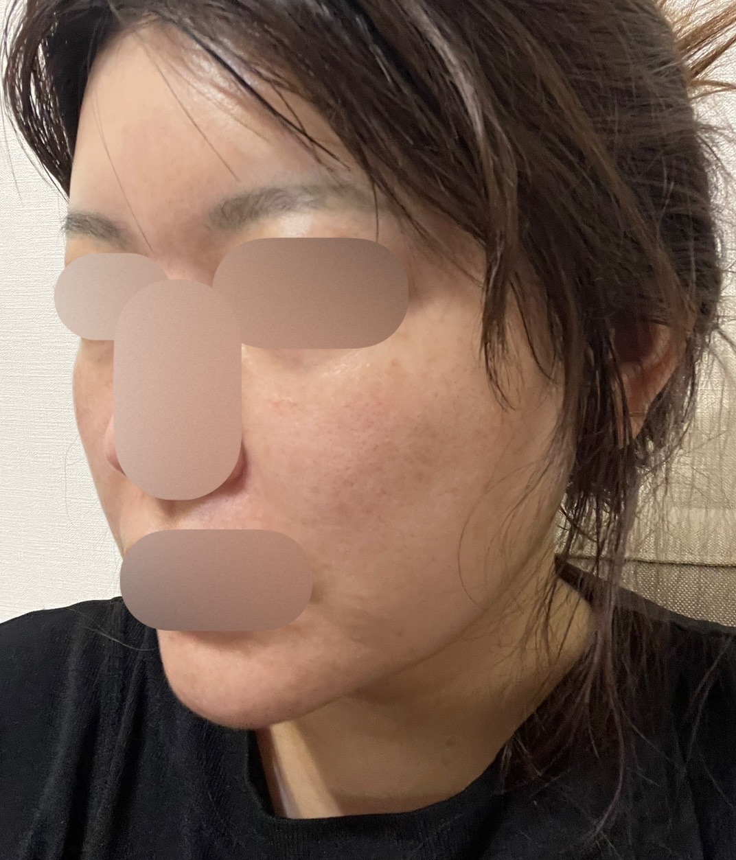 痛みを最小限に抑えたエラビエリトゥオ, リジュラン フルフェイス