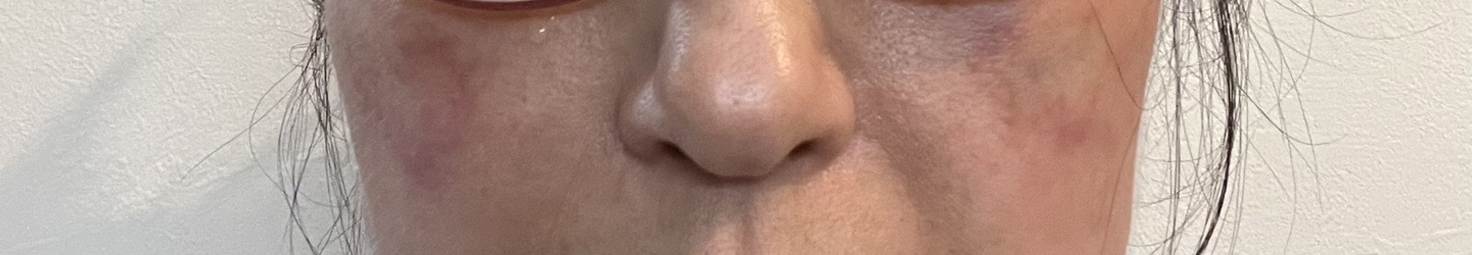 after photo: 脂肪溶解注射(顔)