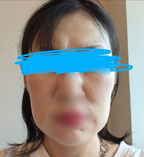 after photo: ピコトーニング