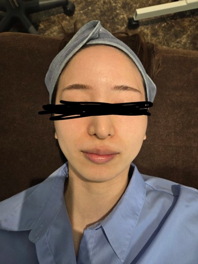 before photo: イオン導入
