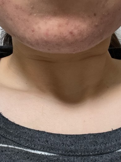 after photo: ダーマペン