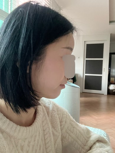after photo: 턱끝필러