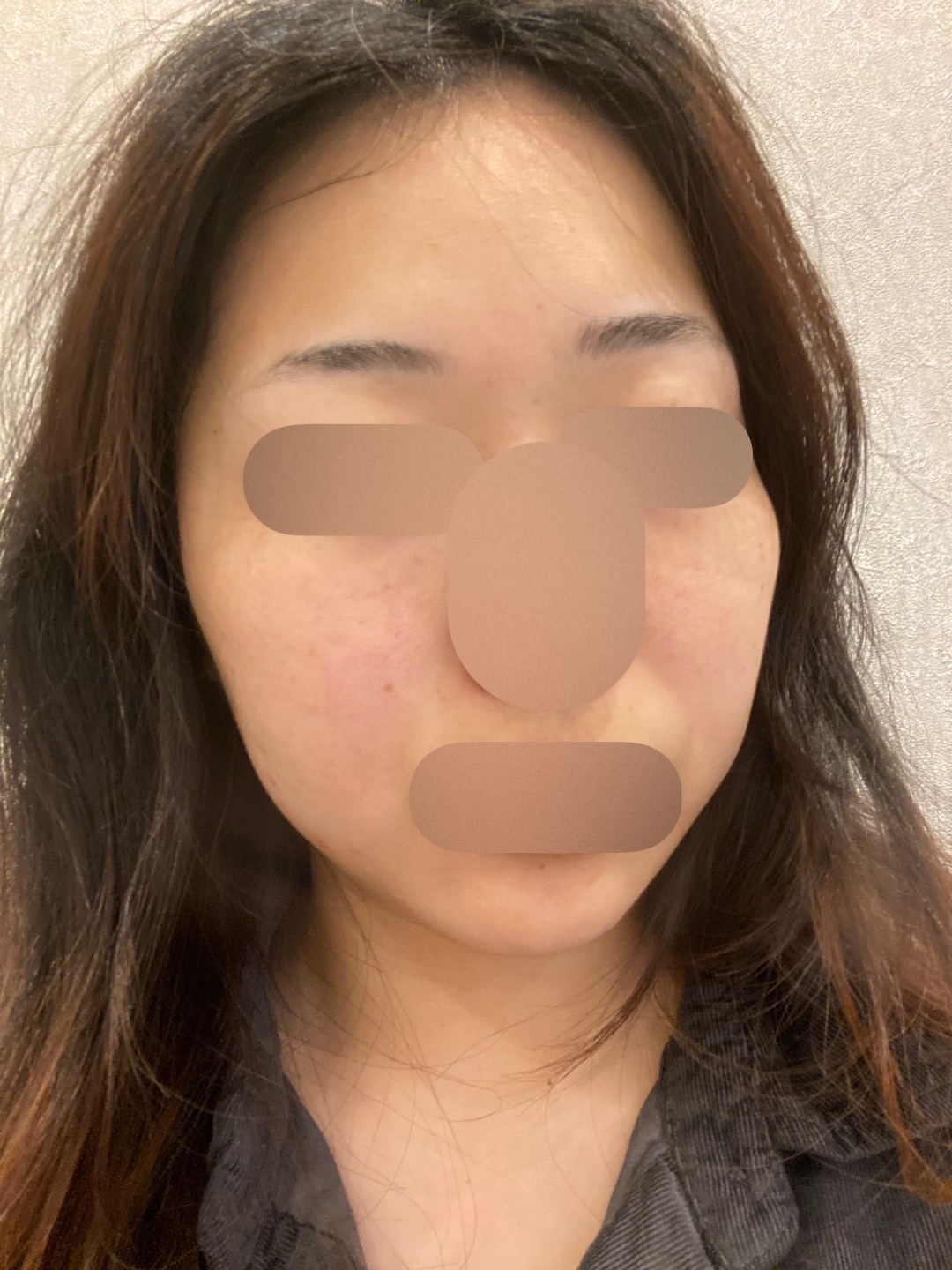何度でも可】IPL（光治療）全顔2周 ｜ステラM22フォトフェイシャル