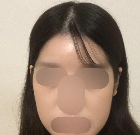 before photo: リジュランヒーラー, スキンボトックス