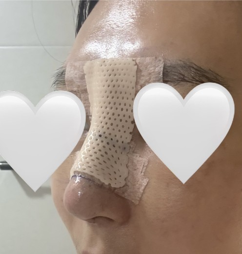 after photo: 콧대(보형물), 코끝(자가연골)