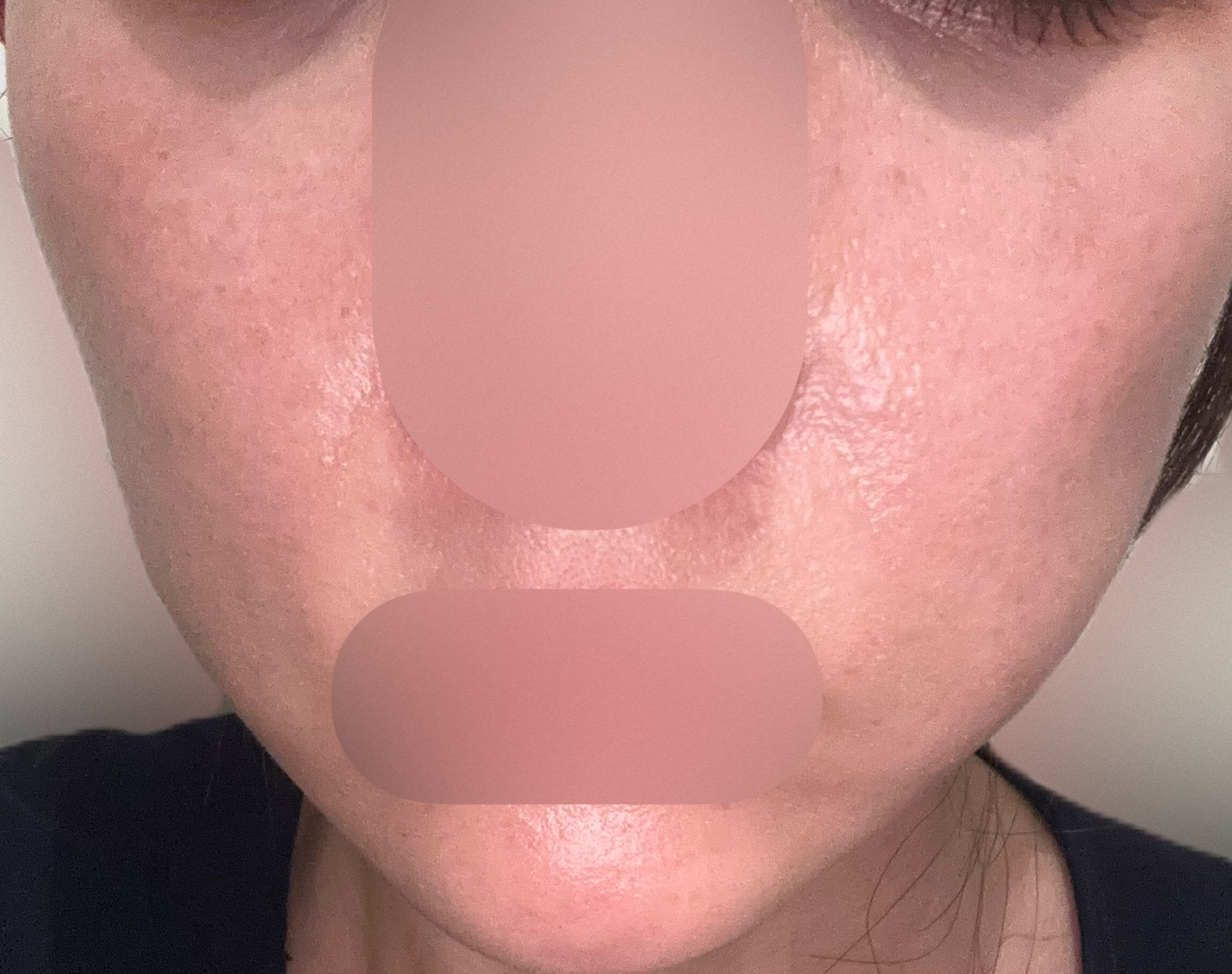 リジュラン 2cc | Karis Beauty Clinic