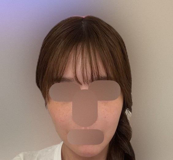 before photo: インモード