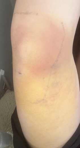 after photo: 脂肪吸引(腕)