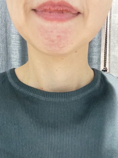 before photo: ダブロ(ハイフ)