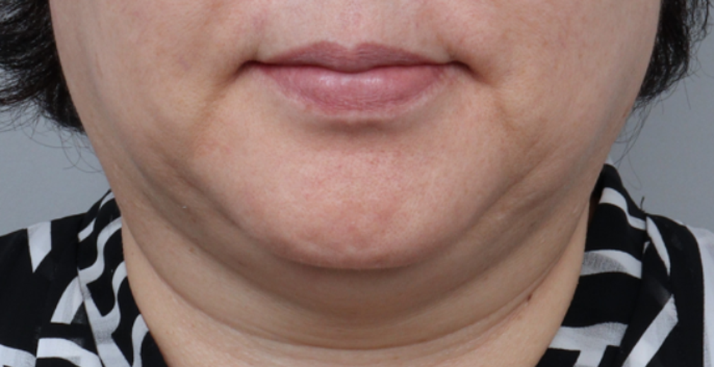 before photo: 실리프팅