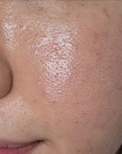 after photo: 리쥬란힐러, 쥬베룩