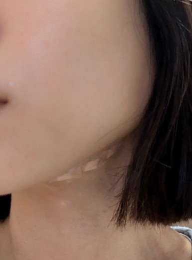 after photo: 糸リフト, メーラー/ジョール/バッカルファット除去