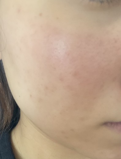 after photo: ダーマペン, ミラノリピール