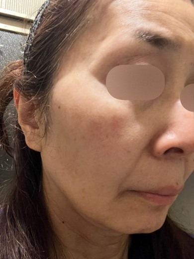 before photo: エレクトロポレーション