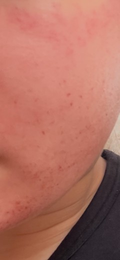 after photo: ダーマペン