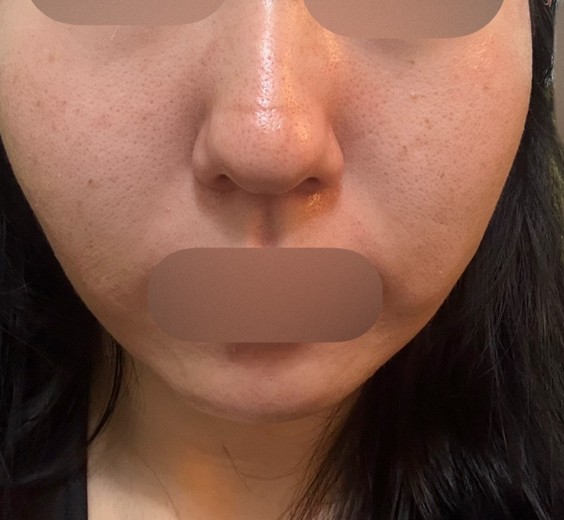 after photo: ルメッカ