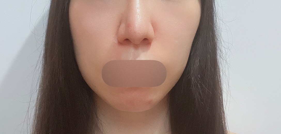 after photo: イオン導入