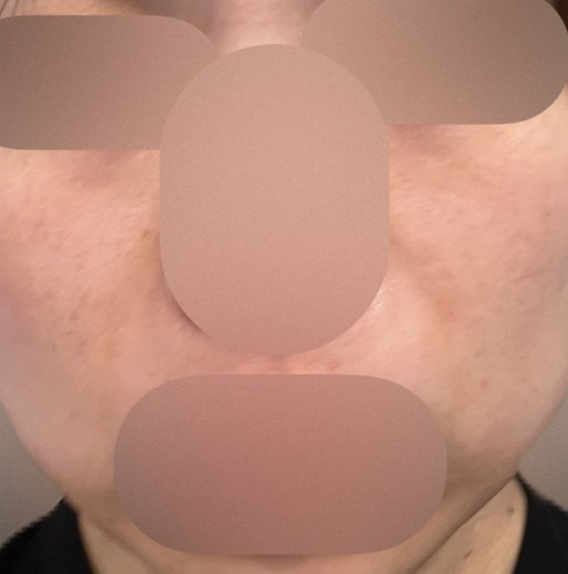 after photo: レーザートーニング, 診断・検査